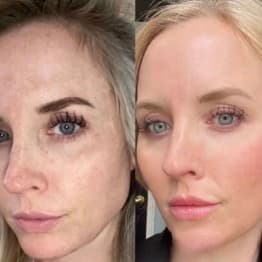 Ultra Glow- Skin Resurfacing at Rise Collective Medspa in New Braunfels, TX