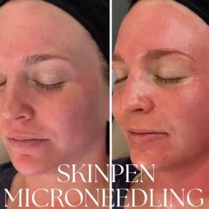 Skin Pen Series + PDRN at Rise Collective Medspa in New Braunfels, TX