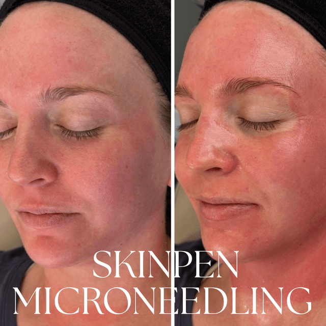 SkinPen series at Rise Collective Medspa in New Braunfels, TX