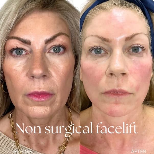 XERF-Skin Tightening at Rise Collective Medspa in New Braunfels, TX