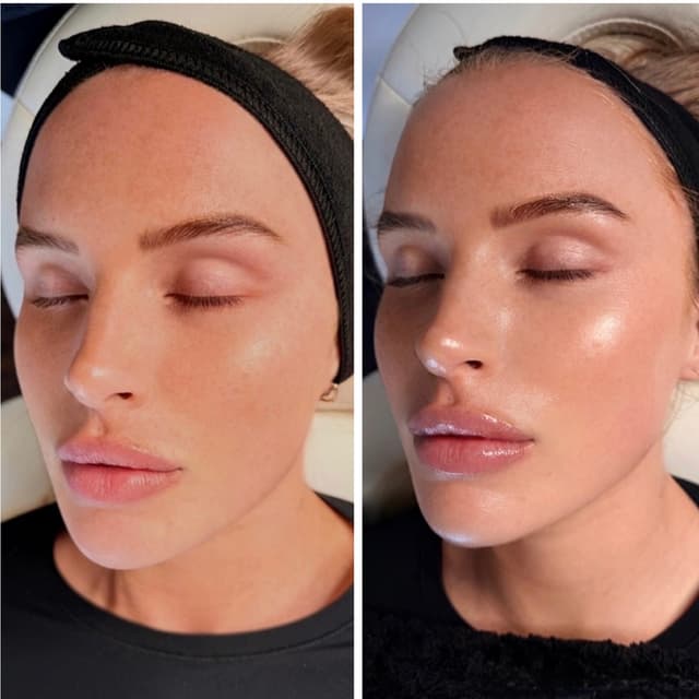 Glo 2 Facial at Rise Collective Medspa in New Braunfels, TX